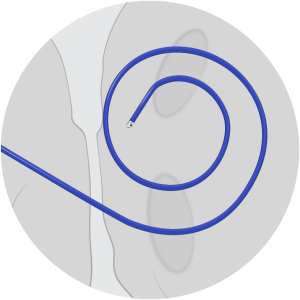 SupraCross® RF Solution - Corpmedical