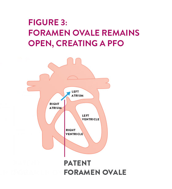 Abbott - AMPLATZER™ PFO - Corpmedical